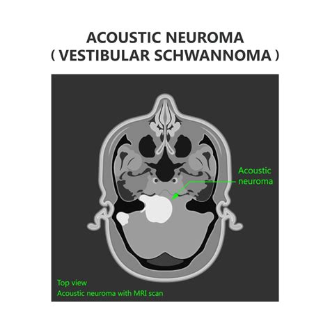 non harmful acoustic neuroma